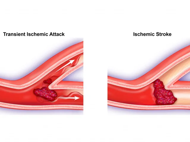 Transient Ischemic Attack and Diabetes: Understanding the Link
